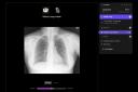 AI will be used to detect diseases, including lung cancer